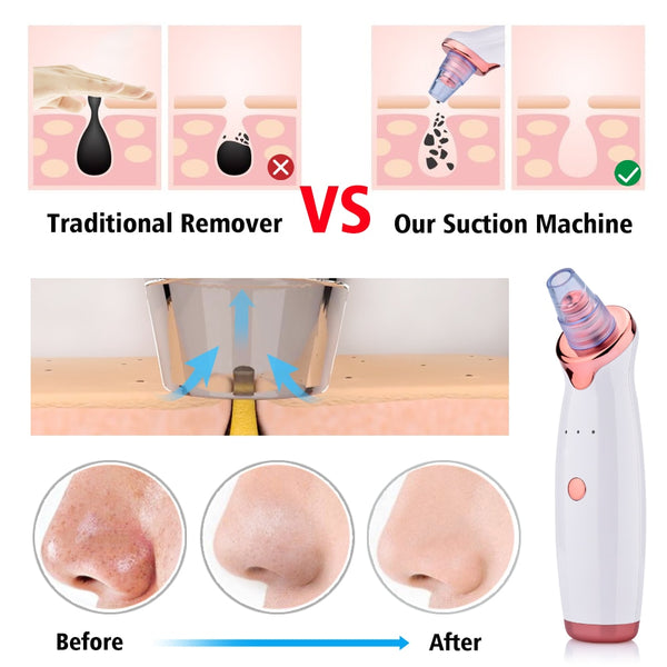 Blackhead Remover Vacuum Pore Cleaner Suction