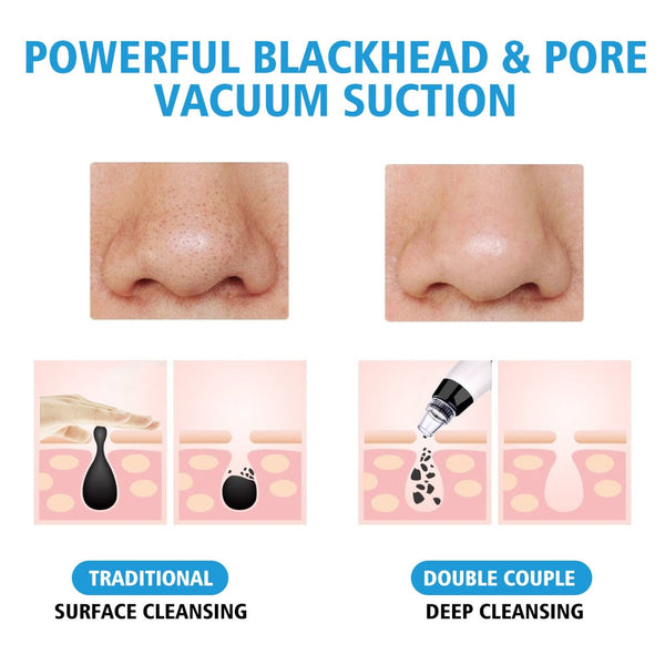 Blackhead Remover Vacuum Pore Cleaner Suction